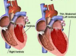 Restoring heart muscle function with pelvic bone stem cells